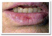 Melanoma Lip Symptoms - Doctor Heck