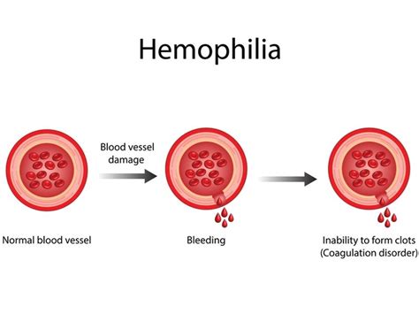 Haemophilia - Symptoms, Causes & Treatment Cost In India