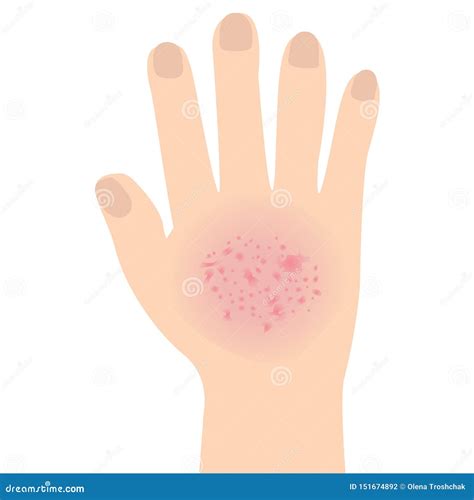 Eczema Affected A Hand Dermatology Skin Disease Concept Stock Vector - Illustration of allergy ...