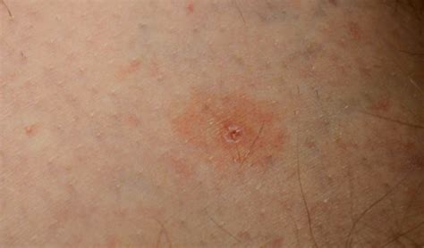 Tick Bite – Pictures, Symptoms, Causes, Treatment | HubPages