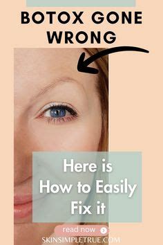 The Easy Fix On How To Correct Spock Eyebrows After Botox | Botox Brow ...