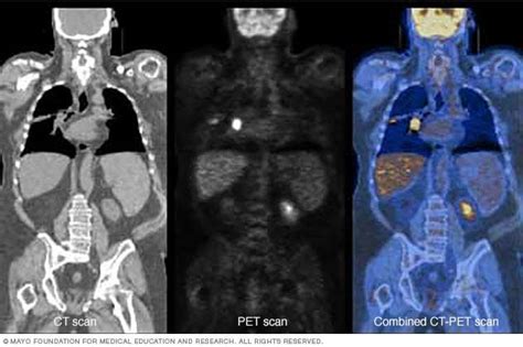 PET plus CT - Mayo Clinic