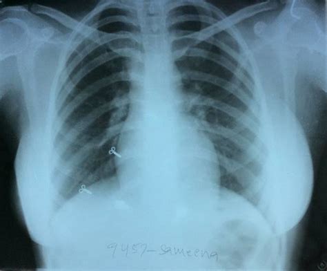 X-Ray Chest PA View -Normal. | Download Scientific Diagram