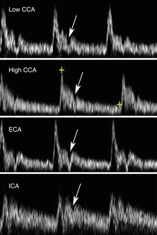 Normal Carotid Artery Ultrasound