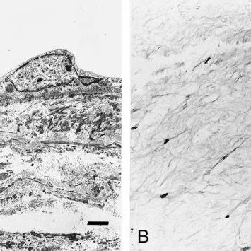 Transmission electron microscopy and light microscopy (case 1). A,... | Download Scientific Diagram