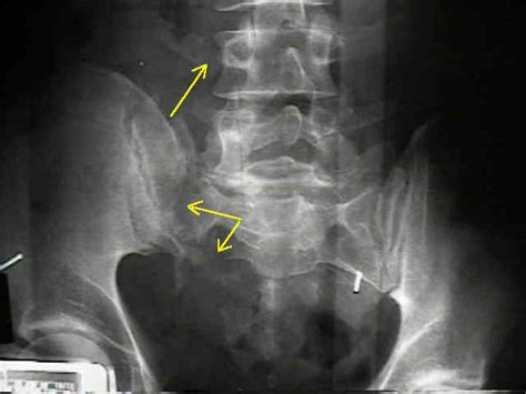 International University: Sacral Fracture