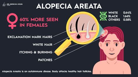 Alopecia Areata: Explaining Autoimmune Hair Loss - Dr Serkan Aygin Clinic