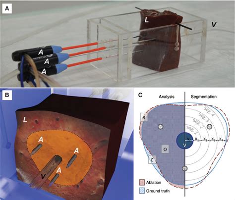 Figure 1 from Intermittent Pringle maneuver may be beneficial for radiofrequency ablations in ...