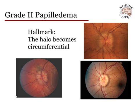 PPT - Idiopathic Intracranial Hypertension Treatment Trial Modified ...