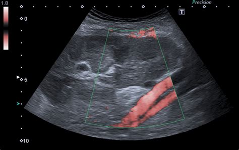 A Doppler ultrasound scan showing absent perfusion of the renal ...