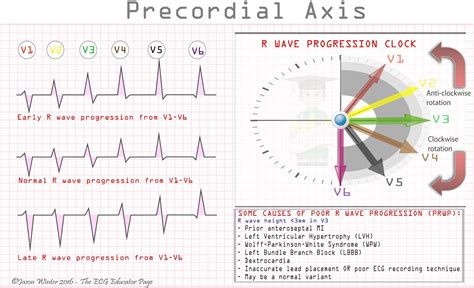 ECG Educator Blog : R-wave Progression