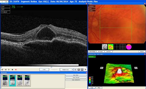 Age-related macular degeneration (AMD) - Wallwork Opticians in Swinton