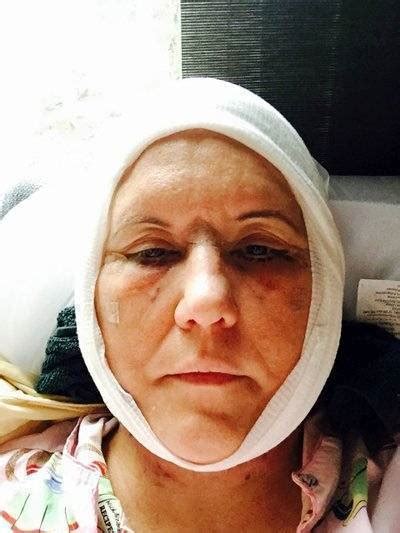 Lower Facelift Recovery Photos (9) » Facelift: Info, Prices, Photos, Reviews, Q&A