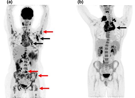 Lymphoma Stage 4 Cancer Pet Scan : Current Status Of Pet Ct In The Diagnosis And Follow Up Of ...