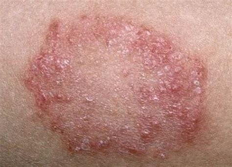 Skin disease or Eczema- Eczema—Also known as atopic dermatitis, this is a long-term skin disease ...