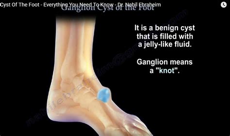 Ganglion Cyst of the Foot — OrthopaedicPrinciples.com