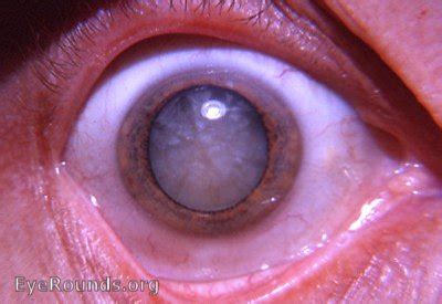 Intumescent cataract. EyeRounds.org: Online Ophthalmic Atlas