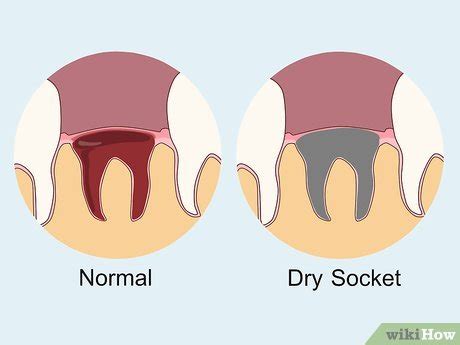 4 Ways to Prevent Dry Socket After a Tooth Extraction - wikiHow