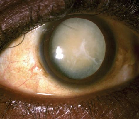 Cataract: No Need to Recommend Change in Hypertensive Med Use