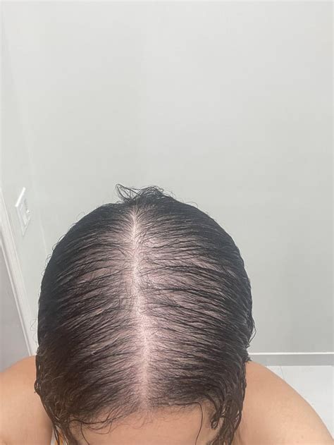 5 month improvement BEFORE AND AFTER : r/FemaleHairLoss