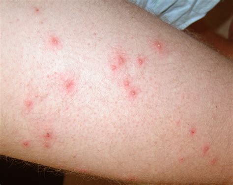 👉 Pseudomonas Folliculitis - Symptoms, Treatment, Pictures, Causes (February 2022)