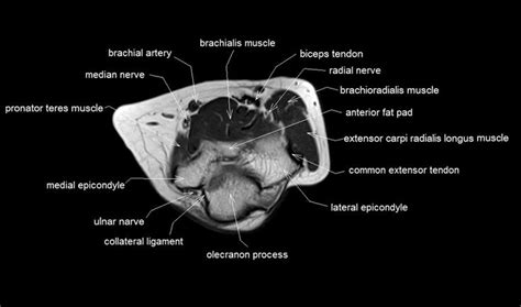 mri anatomy of elbow | axial cross sectional anatomy of elbow joint | Anatomy, Mri, Radial nerve