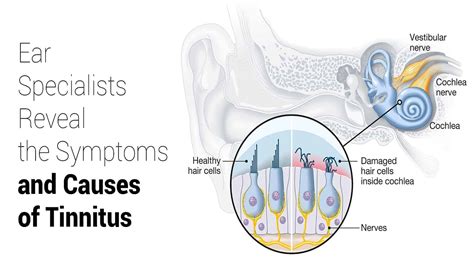 Ear Specialists Reveal the Symptoms and Causes of Tinnitus