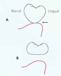 Ovate Pontic - Tooth Structure - Mussen Healthcare