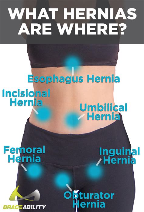 Ventral, Umbilical, Spigelian & Epigastric Hernia Belt Support