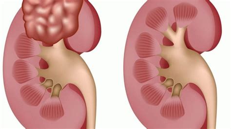 Complex kidney cyst causes and menacing complications