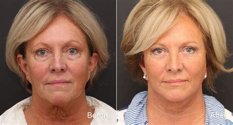 Facelift Photos | Princeton, NJ | Patient 9080