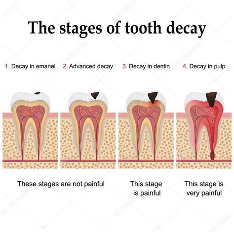 Tooth decay formation Stock Vector Image by ©Neokryuger #98517790