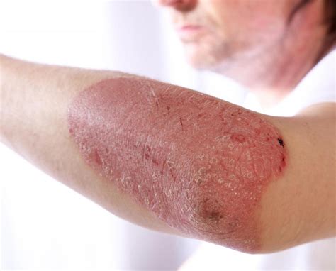 What is Psoriasis? (with pictures)