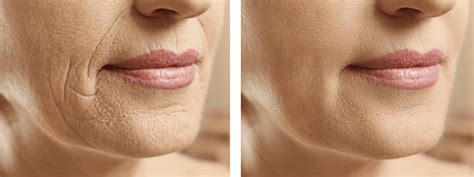 Before & After Laser Treatment for Wrinkles Photo Gallery | The Spa at Spring Ridge