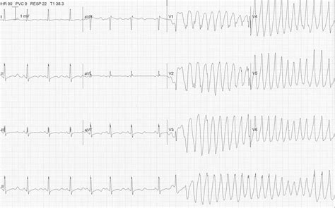 Hypokalemia Ecg Strip