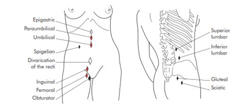 Hernia Pictures: A Visual Guide To Different Hernia Types, 49% OFF