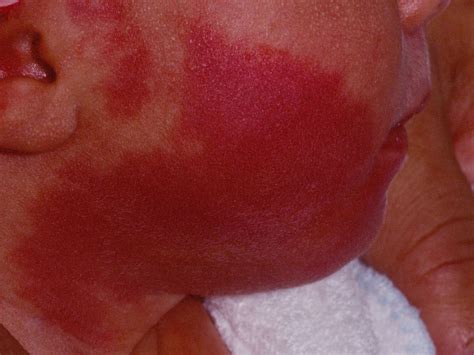 Laser treatment of port wine stains in infancy found safe, effective | MDedge Dermatology