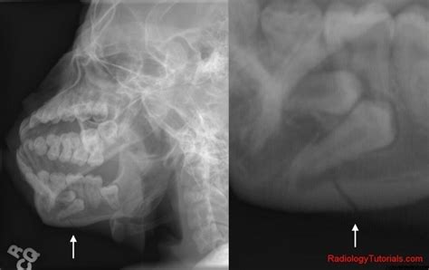 Periapical X Ray Techniques : Types Of Dental Radiographs And Their ...