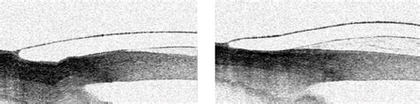 The Evolution of Scleral Lens Fitting - Global Insight