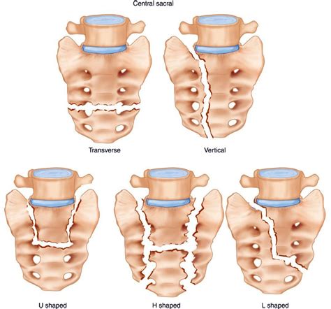 Sacral Fracture - Chiropractic Scientists | 915-850-0900