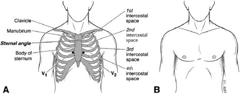 The challenge to anatomically proper placement of precordial leads V1 ...