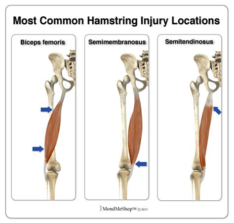 Hamstring Strain Information