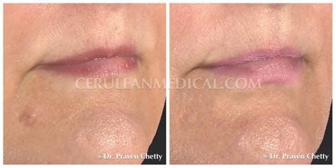 Mole Removal Before and After Photo 3 - Cerulean Medical Institute - Kelowna BC