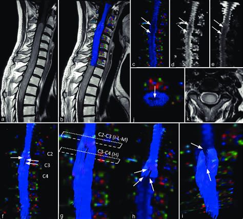 Spinal cord MRI tractography of a young patient affected by spinal... | Download Scientific Diagram