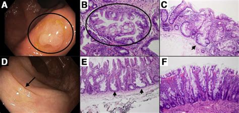 Sessile Serrated Polyp