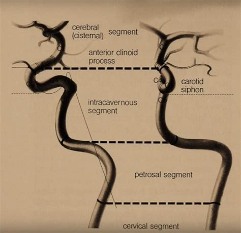 Internal Carotid Artery Segments Radiology