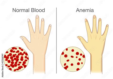 The effect of Anemia on skin blood flow in human. Compared color of people arm. Stock Vector ...