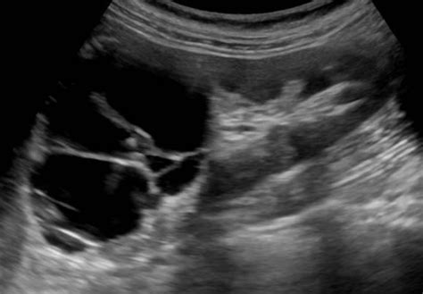 Urinary Tract and male reproductive system | 2.1 Kidney and ureter : Case 2.1.3 Renal cysts ...