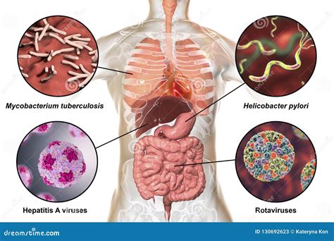 Salmonellosis. Human Intestines And Bacterium That Cause This Disease ...