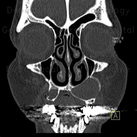 Periapical Cyst Radiograph